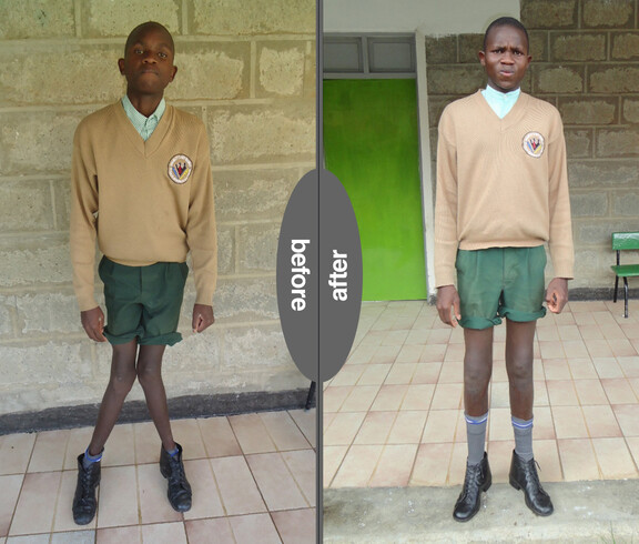 Zwei nebeneinander gestellte Fotos eines Jungen in Schuluniform, links vor der Behandlung, rechts nach der Behandlung.