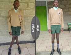 Zwei nebeneinander gestellte Fotos eines Jungen in Schuluniform, links vor der Behandlung, rechts nach der Behandlung.