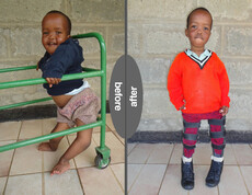 Zwei nebeneinander gestellte Fotos eines Kindes, links mit Gehhilfe, rechts ohne Gehhilfe.